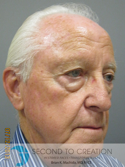 before blepharoplasty right angle view of male patient 5