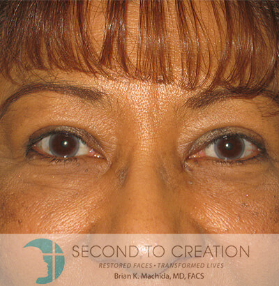 after blepharoplasty front view of patient 978
