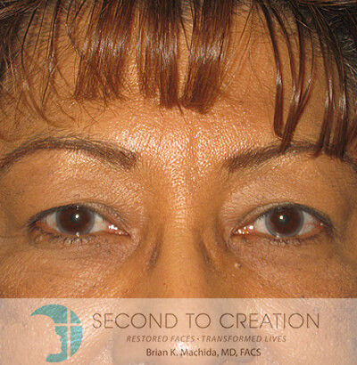 before blepharoplasty front view of patient 978