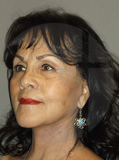 after facelift left angle view of female patient 1