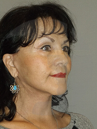 after facelift right angle view of female patient 1
