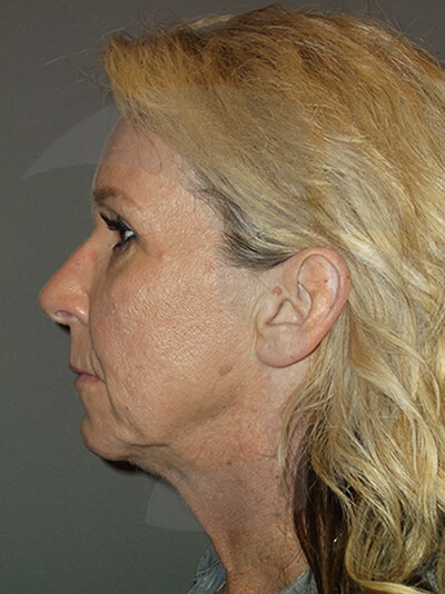 before facelift left side view of female patient 3