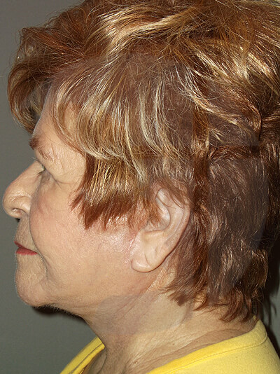 after facelift left side view of female patient 4