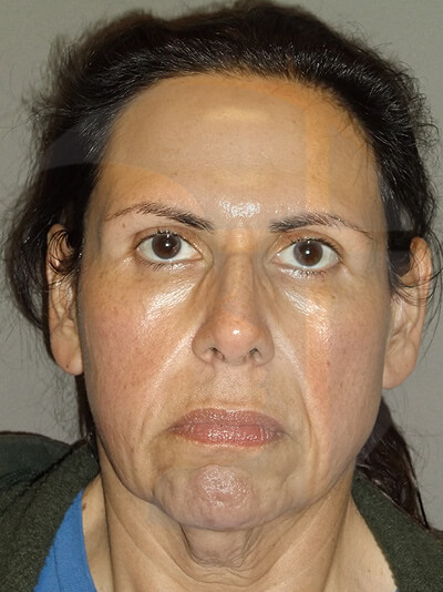 before facelift front view of female patient 5