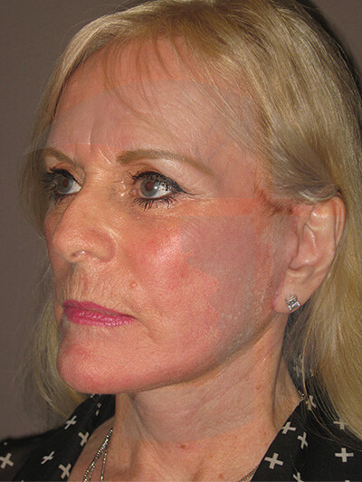 after facelift left angle view of female patient 7