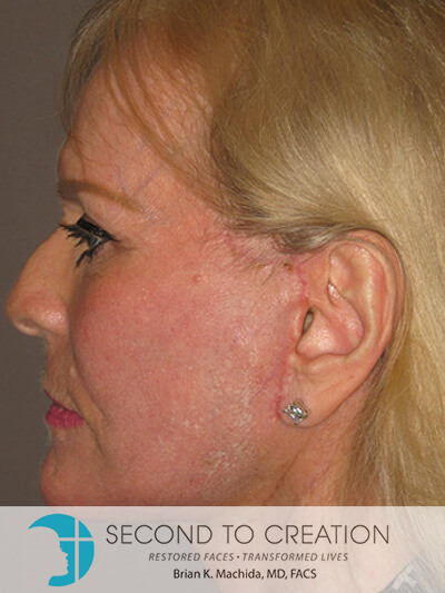after facelift left side closeup view of female patient 7