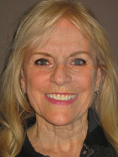 before facelift front view of female patient 7