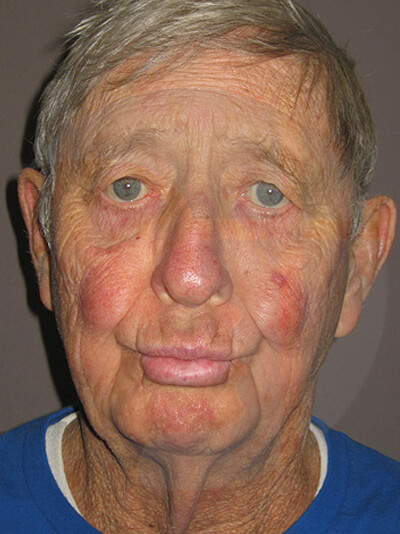 before facelift front view of male patient 8