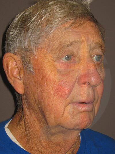 before facelift right angle view of male patient 8