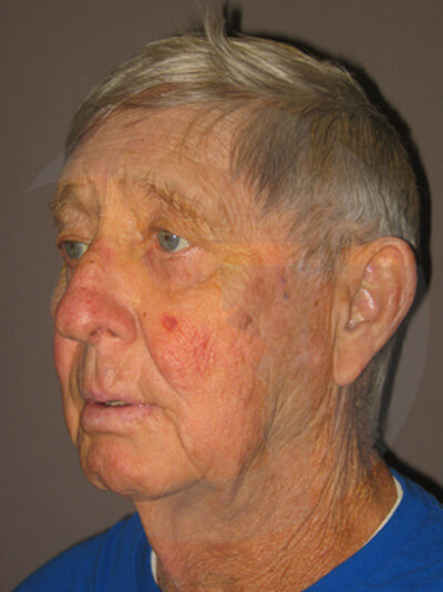before facelift left angle view of male patient 8