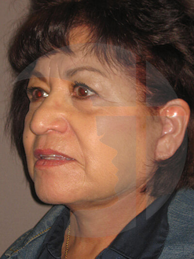after facelift left angle view of female patient 9