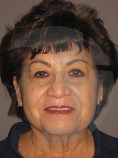 before facelift front view of female patient 9