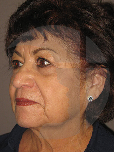 before facelift left angle view of female patient 9