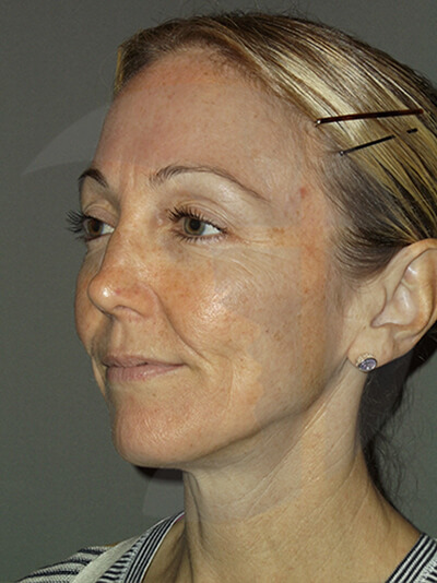before facelift left angle view of female patient 11