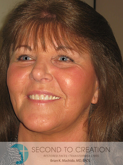 after facelift left angle view of female patient 983