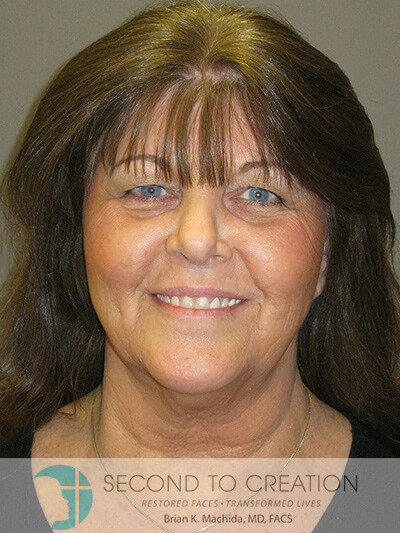 before facelift front view of female patient 983