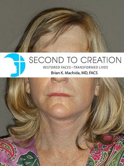 after facelift front view of female patient 2