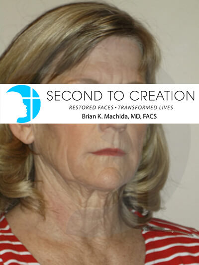 before facelift right angle view of female patient 2