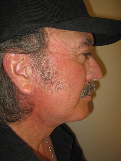 after neck lift liposuction right side view of male patient 1