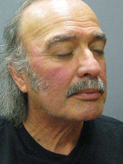 before neck lift liposuction angle view of male patient 1