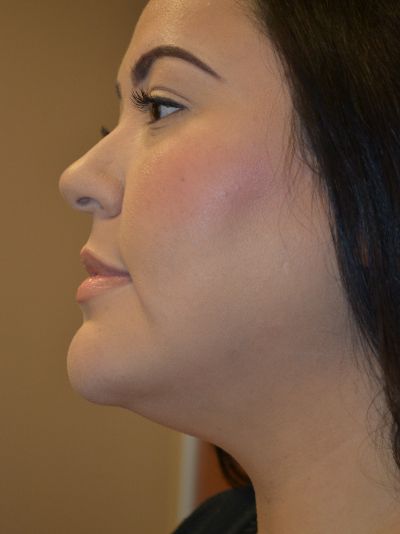 before neck liposuction left side view female patient case 2198