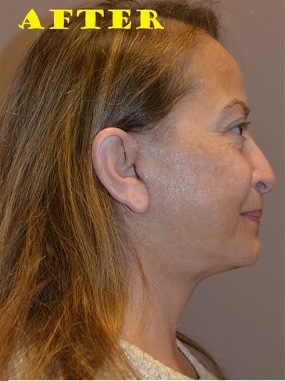 after facelift right view of female patient case 70