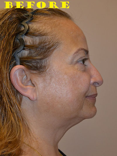 before facelift right view of female patient case 70