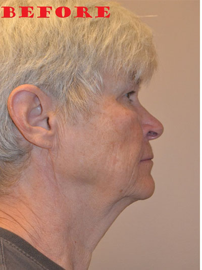 before facelift right view of female patient case 71