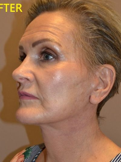 after facelift left angle view of female patient case 73