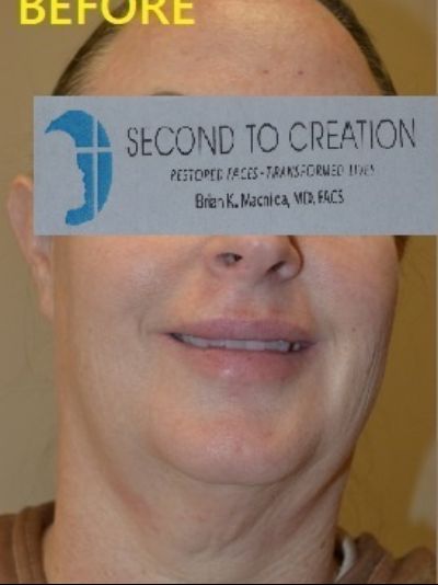 before facelift front view of female patient case 74