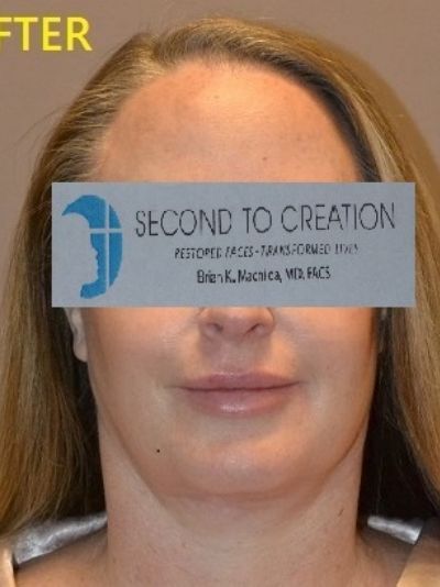 after facelift front view of female patient case 74