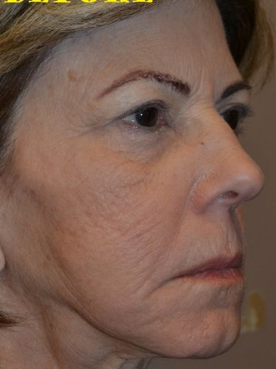 before facelift right view of female patient case 75