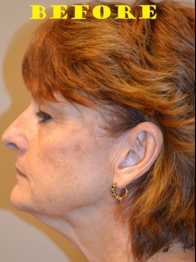 before facelift left view of female patient case 76