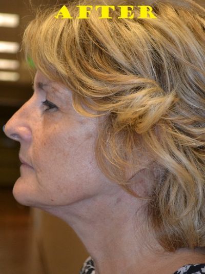 after facelift left view of female patient case 76