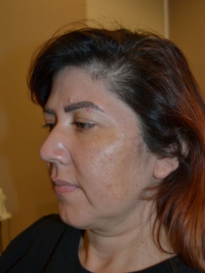 before facelift left angle view of female patient case 77