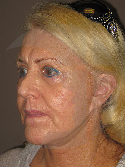 before blepharoplasty left angle view of female patient 1034