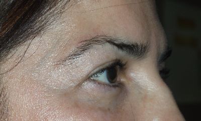 after blepharoplasty right side view of patient 7