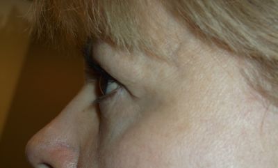 before blepharoplasty left side view of patient 11