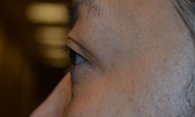 after blepharoplasty left side view of patient 12