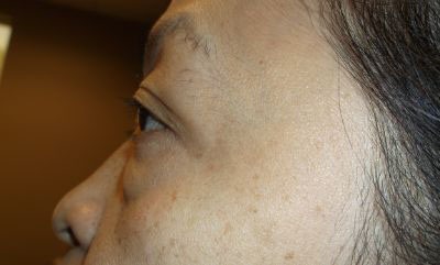 before blepharoplasty left side view of patient 12