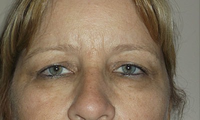 before blepharoplasty front view of patient 1688