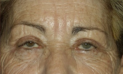 after blepharoplasty front view of patient 1736