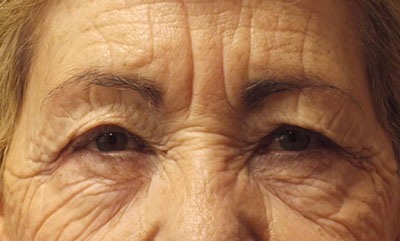 before blepharoplasty front view of patient 1736