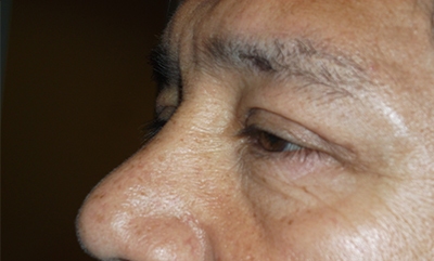 after blepharoplasty left side view of patient 1756