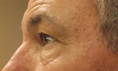 before blepharoplasty left side view of patient 1789