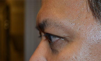 after blepharoplasty left side view of patient 1835