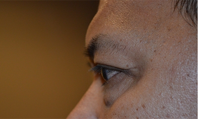 before blepharoplasty left side view of patient 1835