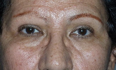 before blepharoplasty front view female patient case 1900