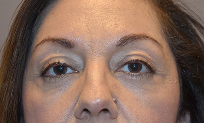 after blepharoplasty front view of patient 23