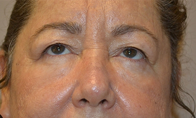 before blepharoplasty front view female patient 24